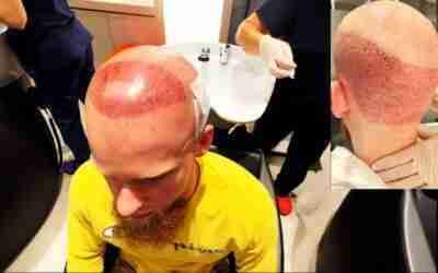 JUSTIN'S HAIR TRANSPLANT AT COSMEDICA VLOG | HAIRLICIOUSLY